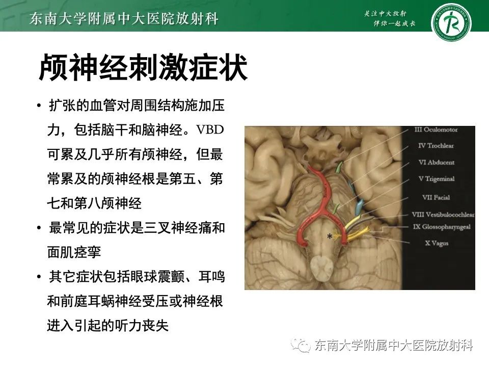 影像PPT - 【PPT】椎基底动脉延长扩张症-20