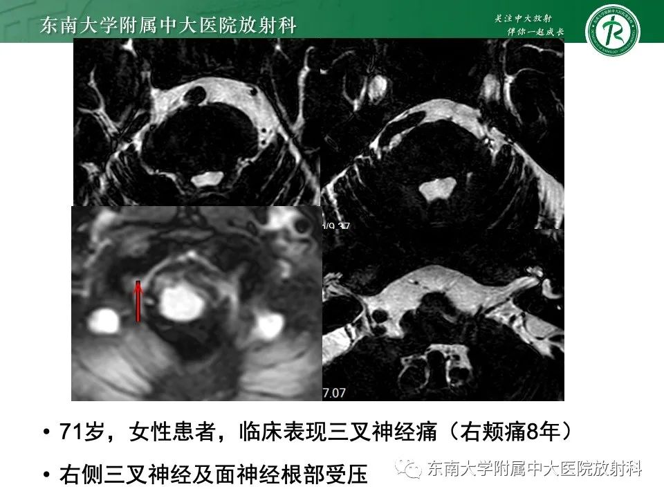 影像PPT - 【PPT】椎基底动脉延长扩张症-22