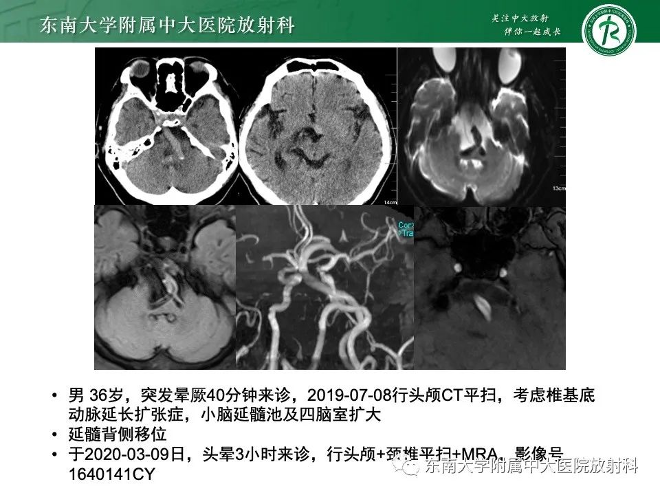 影像PPT - 【PPT】椎基底动脉延长扩张症-26