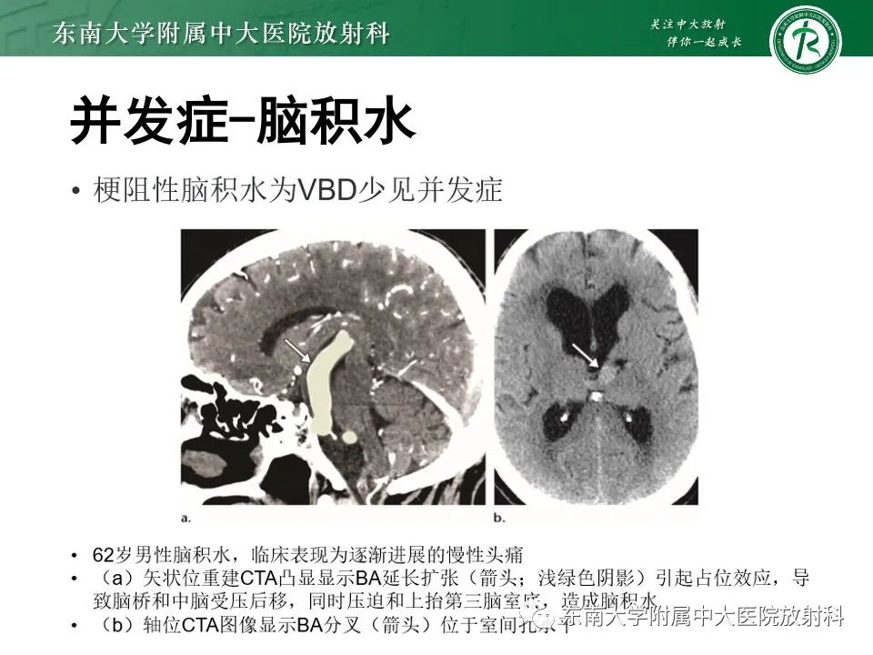 影像PPT - 【PPT】椎基底动脉延长扩张症-27