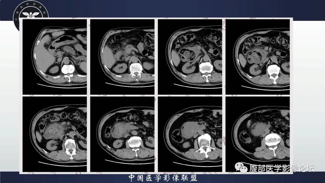 影像PPT - 【病例】十二指肠腺癌1例CT影像-3 影像PPT - 【病例】十二指肠腺癌1例CT影像-3