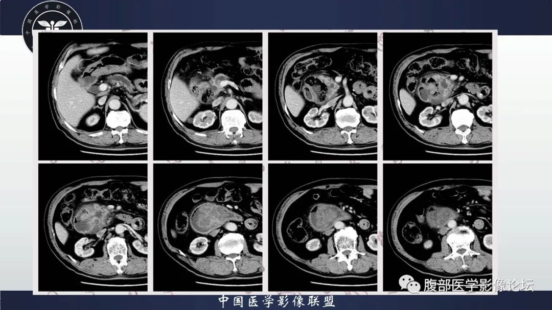 影像PPT - 【病例】十二指肠腺癌1例CT影像-4 影像PPT - 【病例】十二指肠腺癌1例CT影像-4