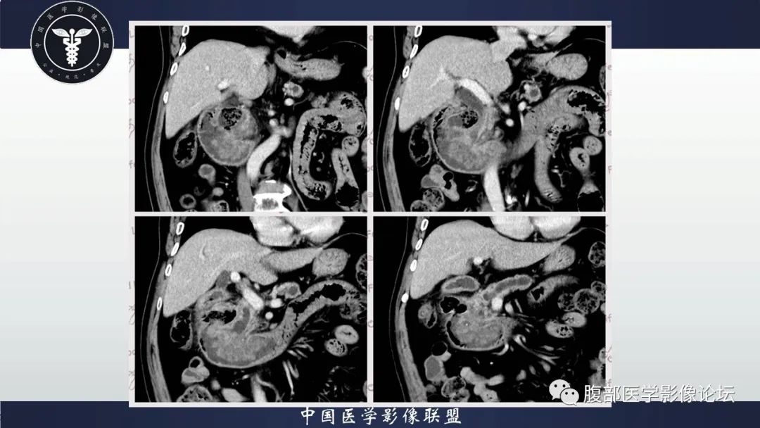 影像PPT - 【病例】十二指肠腺癌1例CT影像-6 影像PPT - 【病例】十二指肠腺癌1例CT影像-6