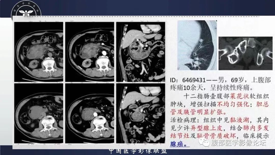 影像PPT - 【病例】十二指肠腺癌1例CT影像-7 影像PPT - 【病例】十二指肠腺癌1例CT影像-7
