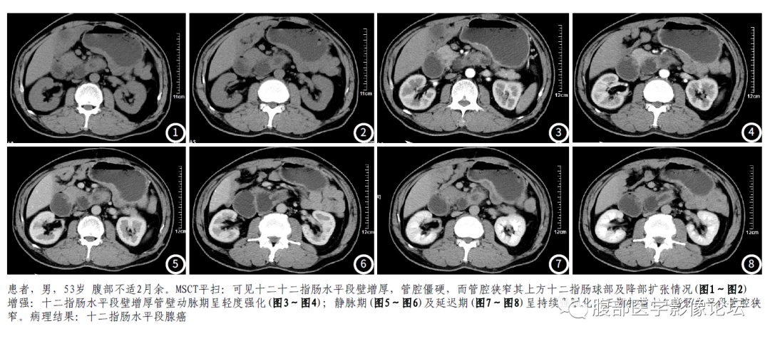 影像PPT - 【病例】十二指肠腺癌1例CT影像-8 影像PPT - 【病例】十二指肠腺癌1例CT影像-8