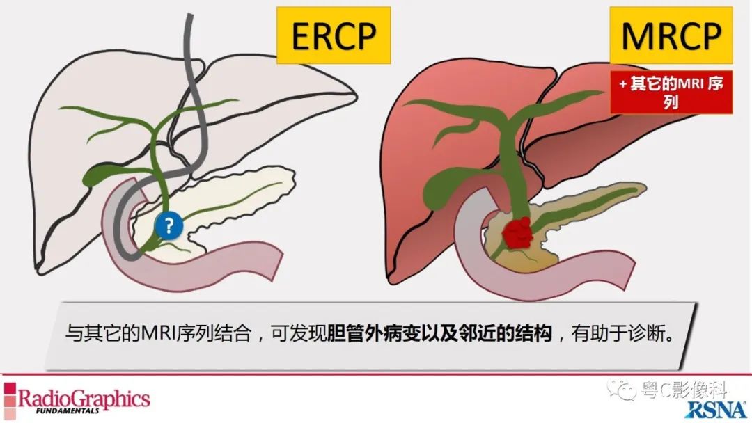 影像PPT - 【PPT】MRCP：放射医师必知-7