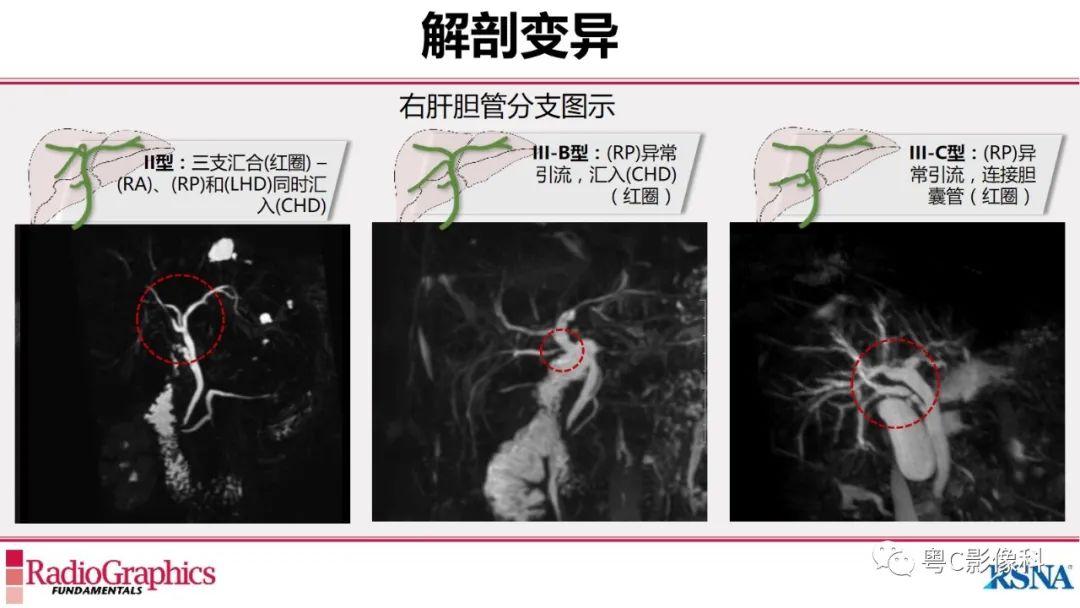 影像PPT - 【PPT】MRCP：放射医师必知-10