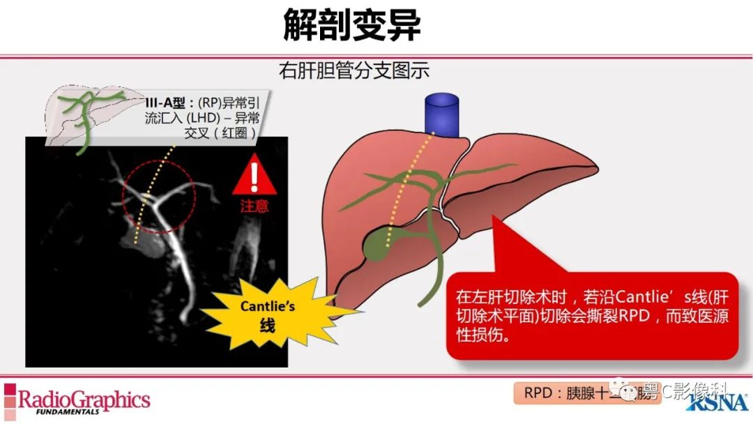 影像PPT - 【PPT】MRCP：放射医师必知-11