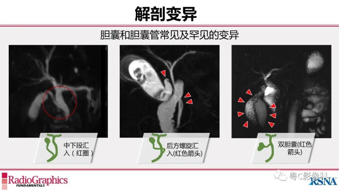 影像PPT - 【PPT】MRCP：放射医师必知-14