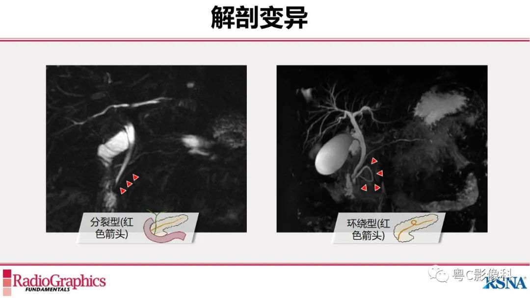 影像PPT - 【PPT】MRCP：放射医师必知-17