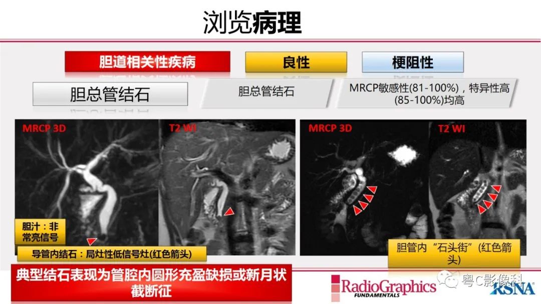 影像PPT - 【PPT】MRCP：放射医师必知-26