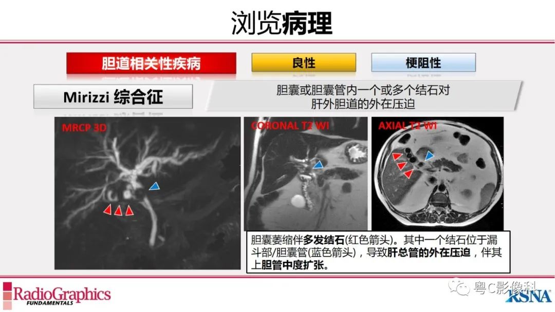 影像PPT - 【PPT】MRCP：放射医师必知-27