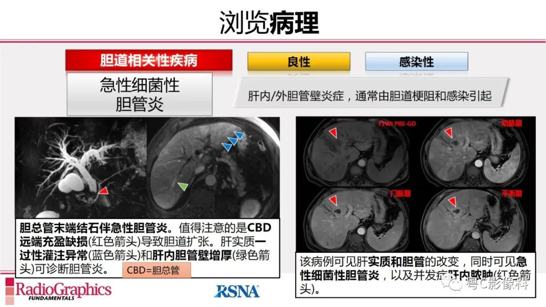 影像PPT - 【PPT】MRCP：放射医师必知-28