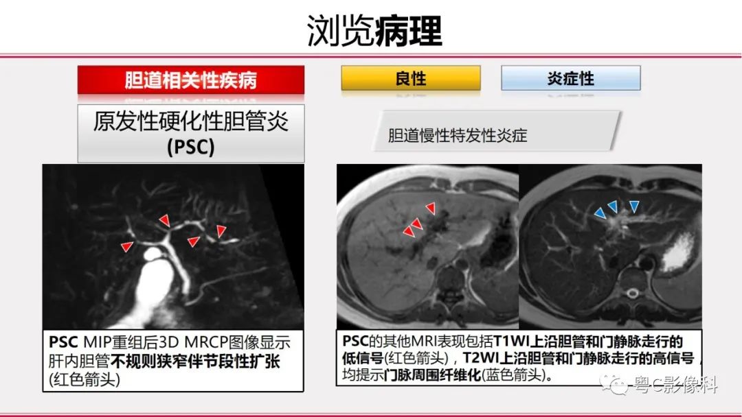 影像PPT - 【PPT】MRCP：放射医师必知-29