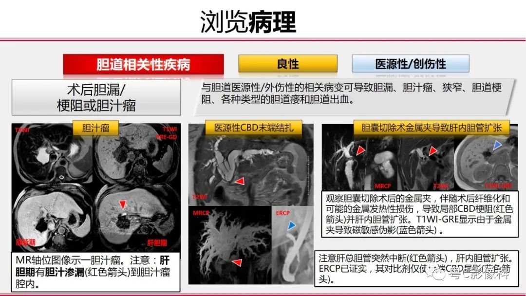 影像PPT - 【PPT】MRCP：放射医师必知-30