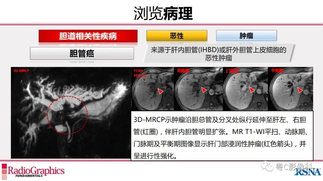 影像PPT - 【PPT】MRCP：放射医师必知-31