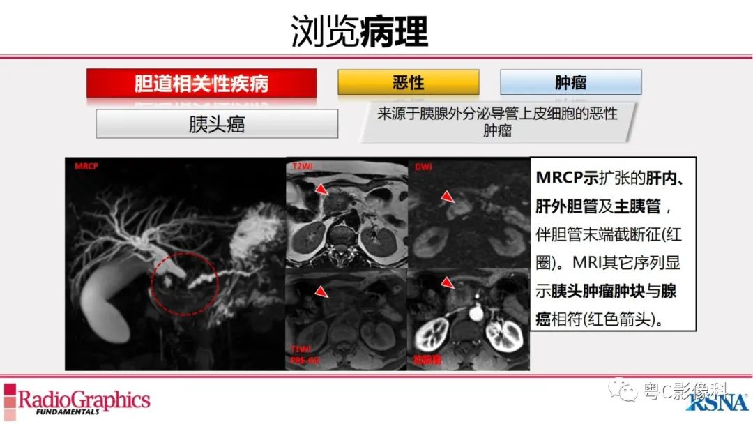 影像PPT - 【PPT】MRCP：放射医师必知-32