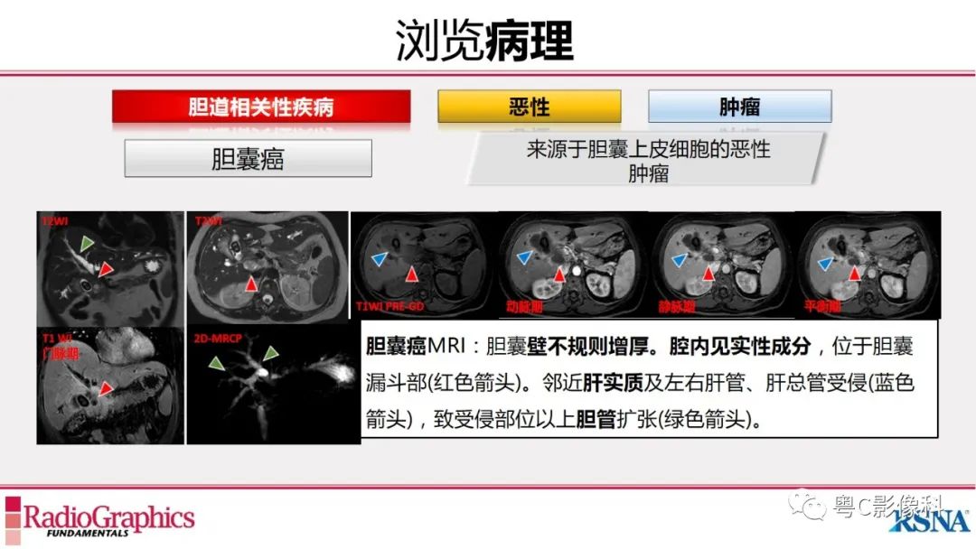 影像PPT - 【PPT】MRCP：放射医师必知-33