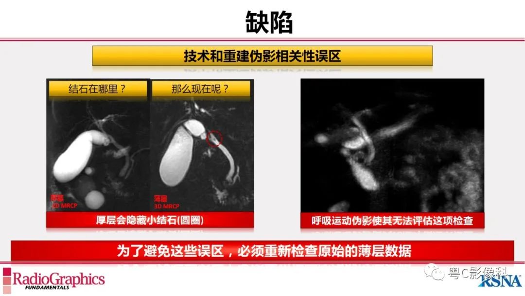 影像PPT - 【PPT】MRCP：放射医师必知-37