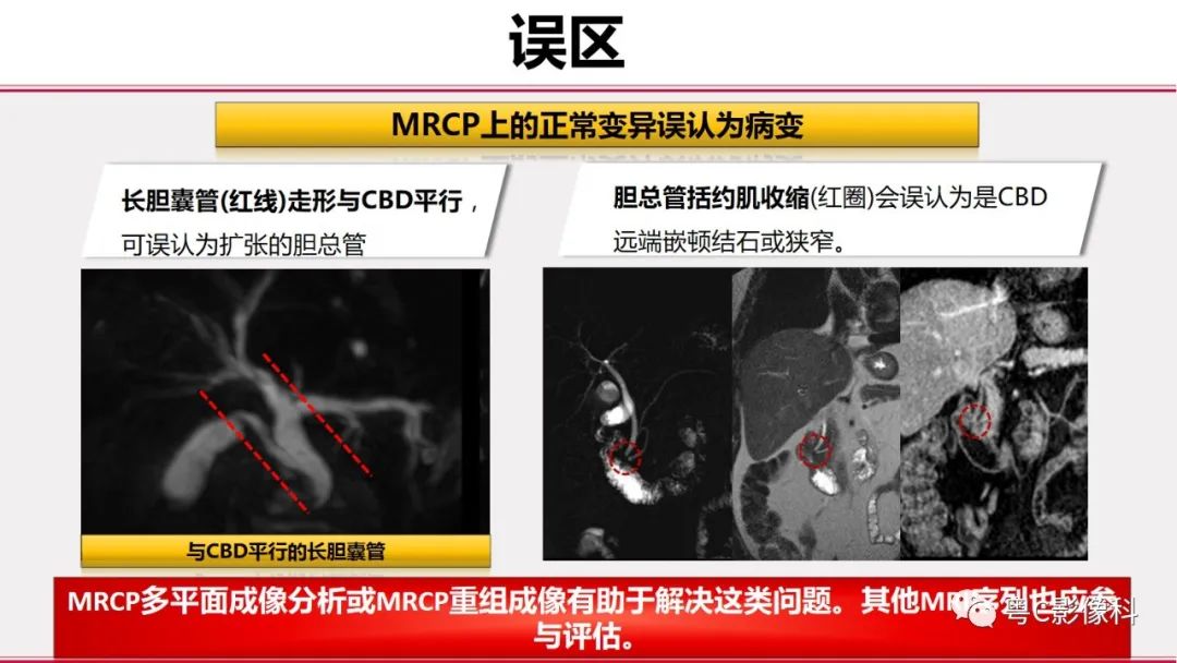 影像PPT - 【PPT】MRCP：放射医师必知-38