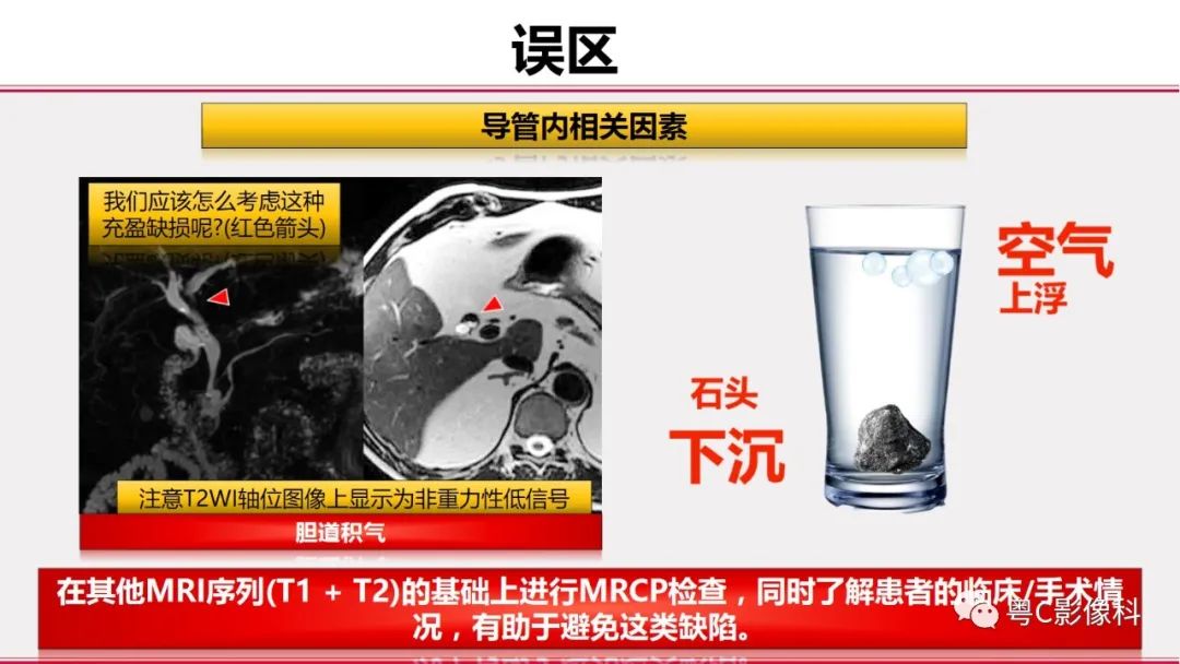 影像PPT - 【PPT】MRCP：放射医师必知-40