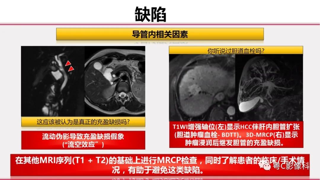 影像PPT - 【PPT】MRCP：放射医师必知-41