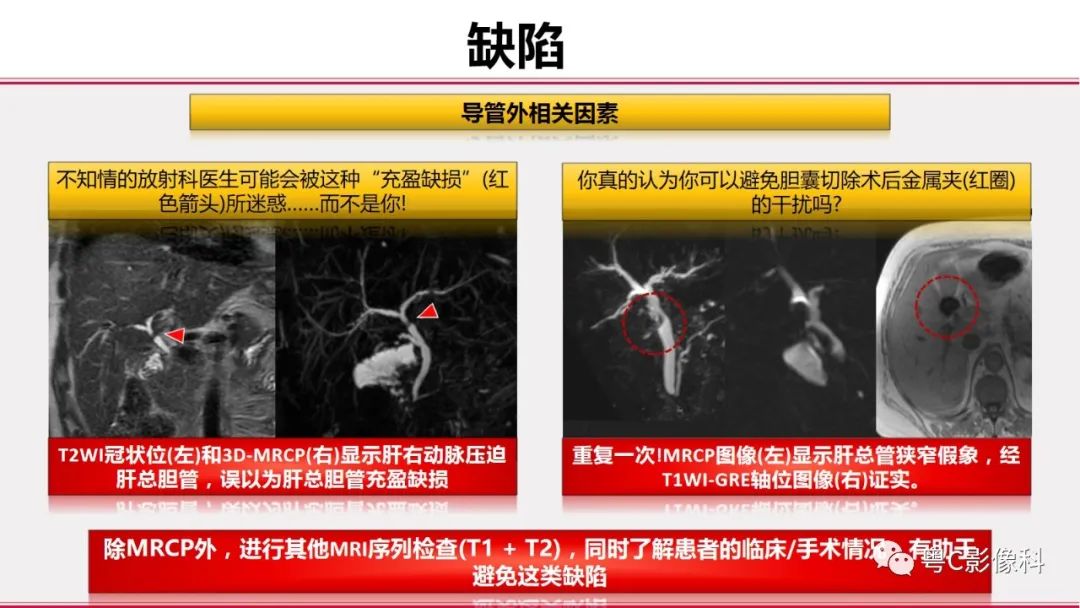 影像PPT - 【PPT】MRCP：放射医师必知-43