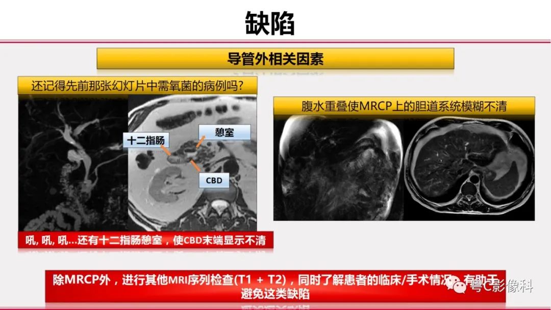 影像PPT - 【PPT】MRCP：放射医师必知-44
