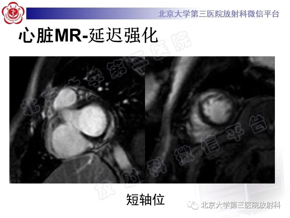 影像PPT - 【PPT】心肌炎-3
