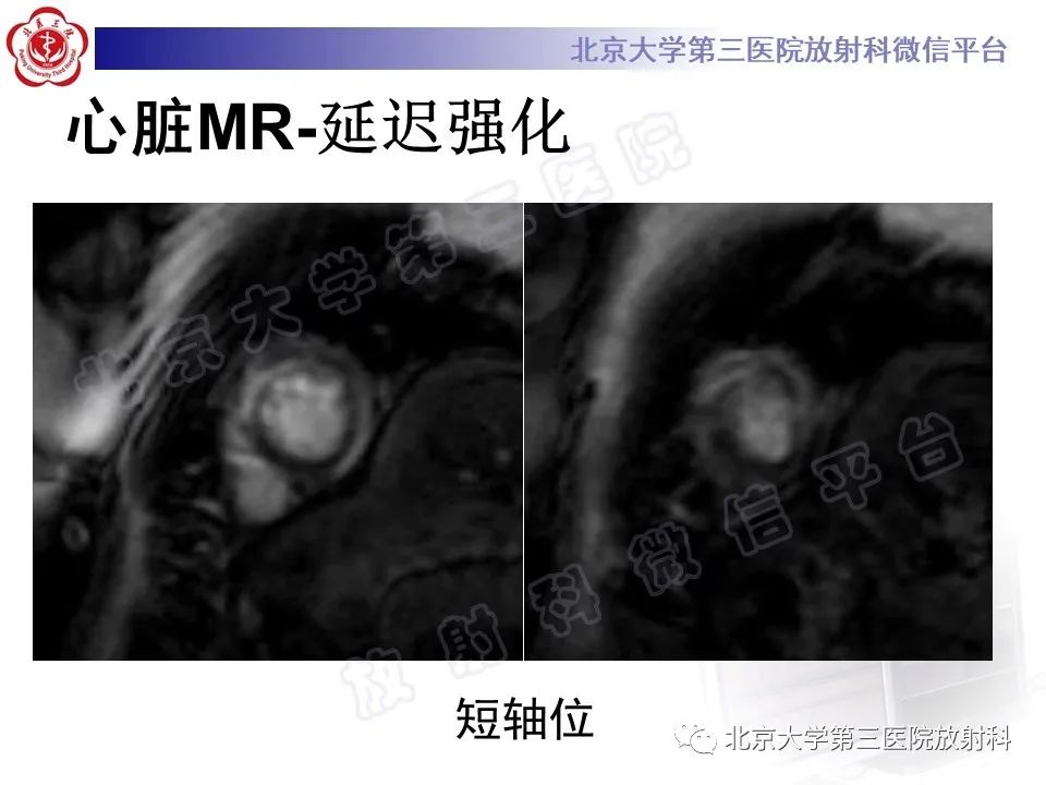 影像PPT - 【PPT】心肌炎-4