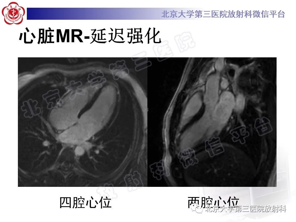 影像PPT - 【PPT】心肌炎-5