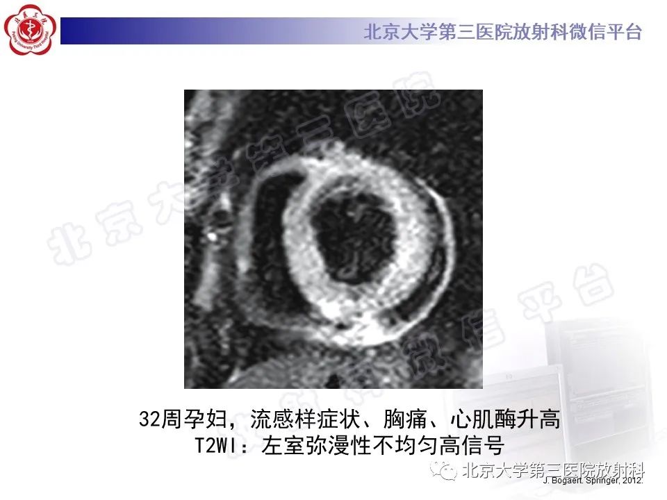 影像PPT - 【PPT】心肌炎-16