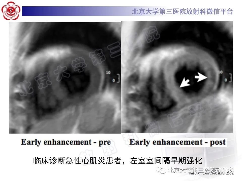 影像PPT - 【PPT】心肌炎-18