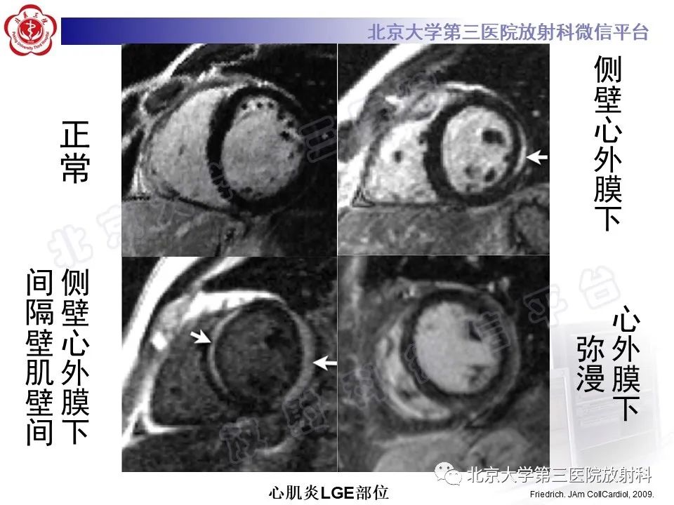 影像PPT - 【PPT】心肌炎-21