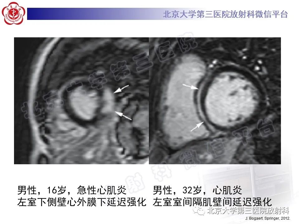 影像PPT - 【PPT】心肌炎-23