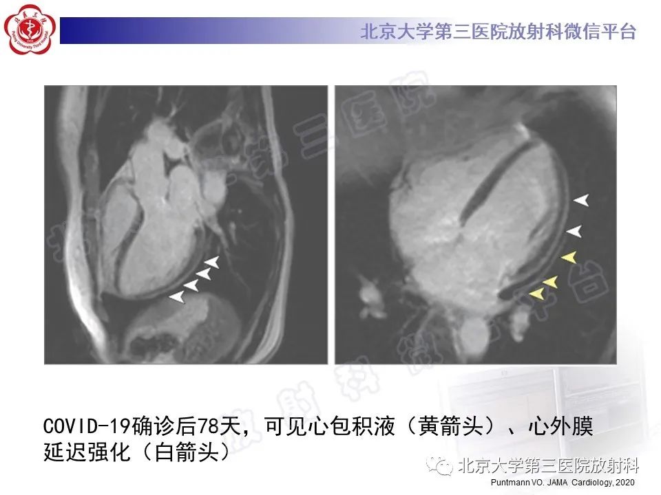 影像PPT - 【PPT】心肌炎-24