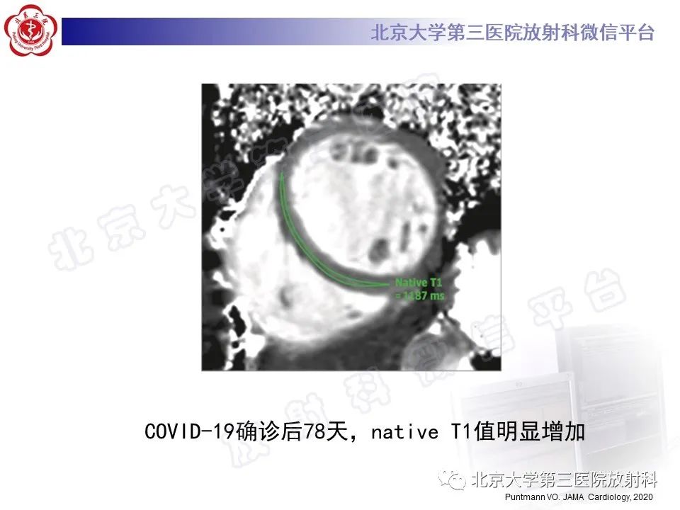 影像PPT - 【PPT】心肌炎-26