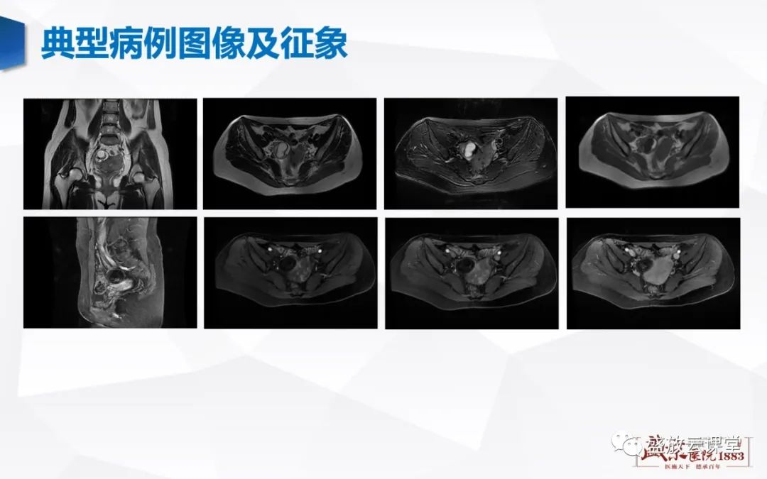 影像PPT - 【PPT】卵巢肿瘤-4