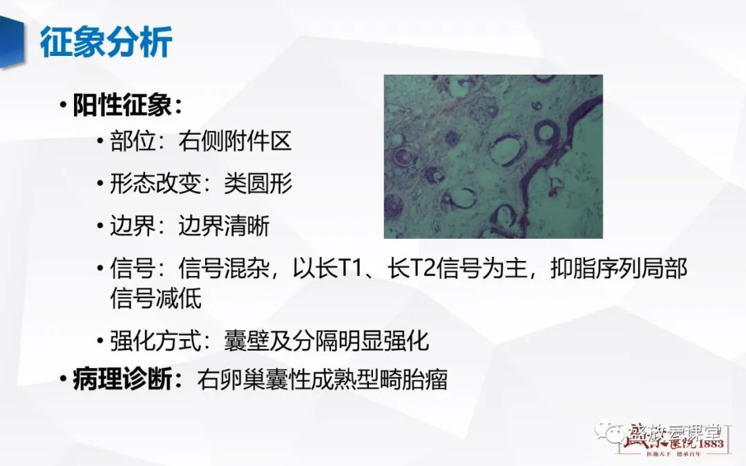 影像PPT - 【PPT】卵巢肿瘤-6