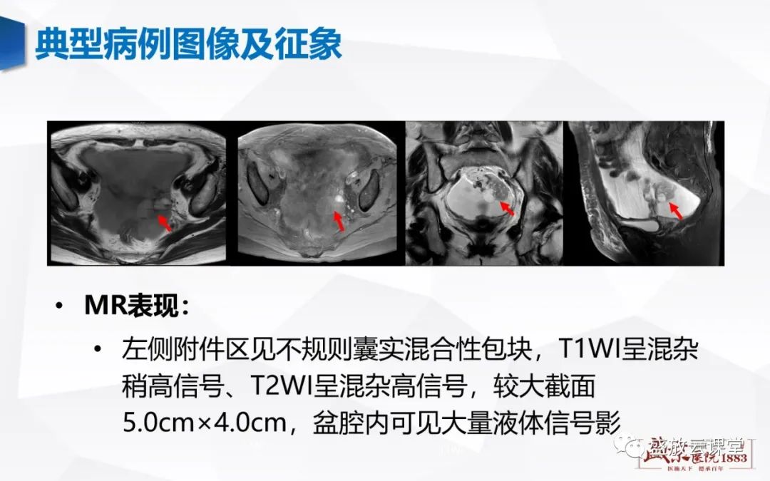 影像PPT - 【PPT】卵巢肿瘤-10