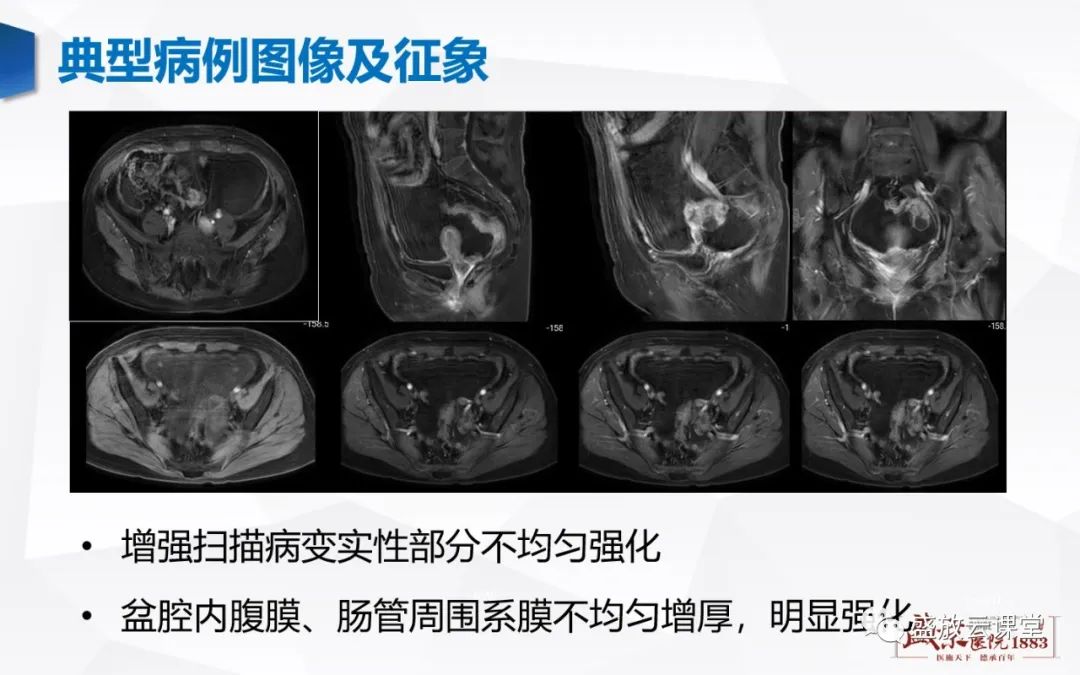 影像PPT - 【PPT】卵巢肿瘤-11