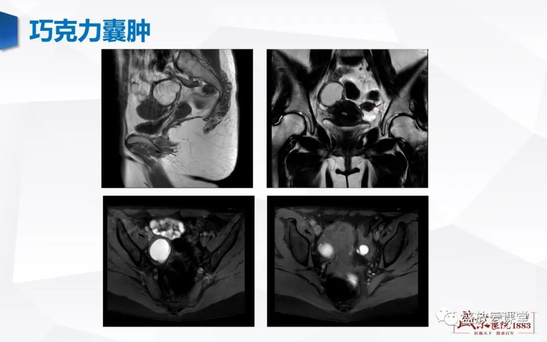 影像PPT - 【PPT】卵巢肿瘤-16