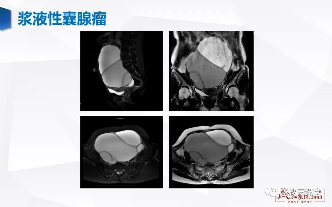 影像PPT - 【PPT】卵巢肿瘤-19