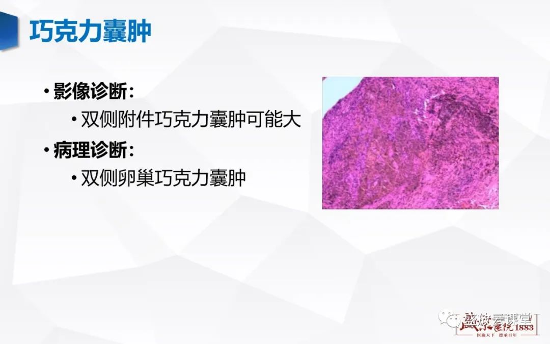 影像PPT - 【PPT】卵巢肿瘤-18