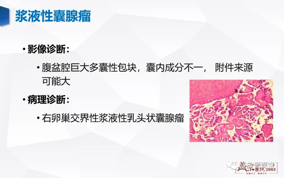 影像PPT - 【PPT】卵巢肿瘤-21