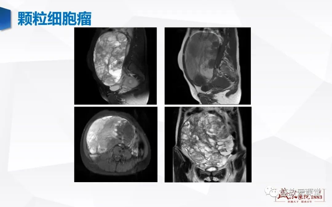 影像PPT - 【PPT】卵巢肿瘤-22
