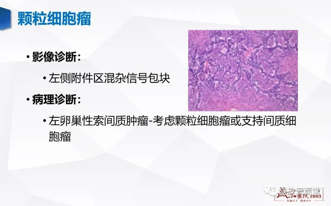 影像PPT - 【PPT】卵巢肿瘤-24