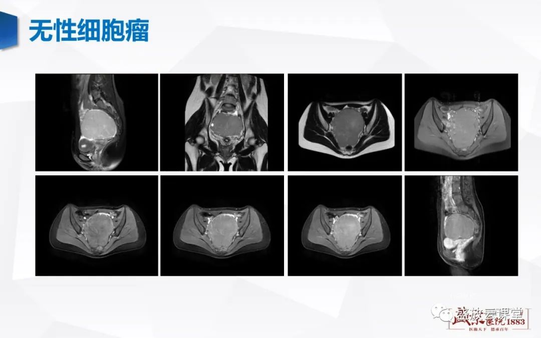 影像PPT - 【PPT】卵巢肿瘤-25