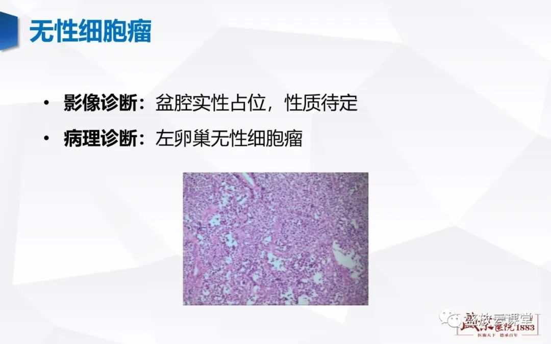 影像PPT - 【PPT】卵巢肿瘤-27