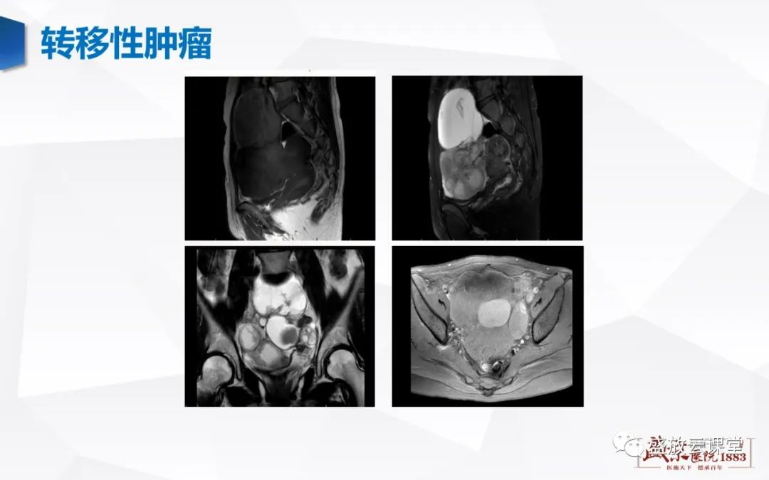 影像PPT - 【PPT】卵巢肿瘤-28
